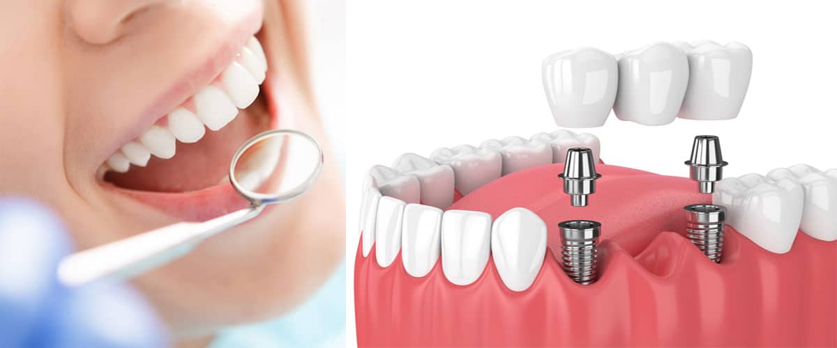 ایمپلنت دندانی